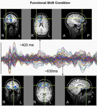 Imagen: efectos de los cambios funcionales en el cerebro. Un. Liverpool
